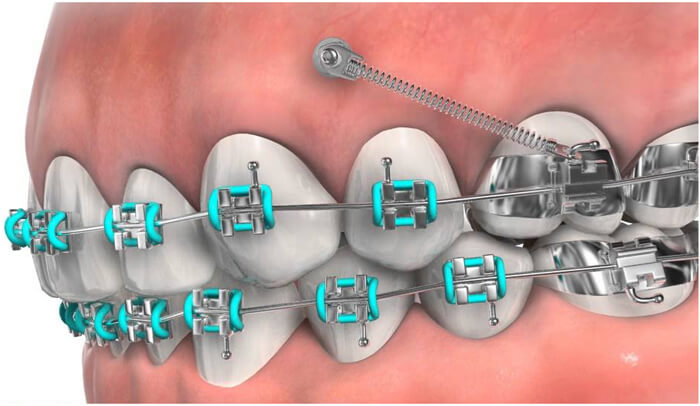 dental braces installation in Ajman