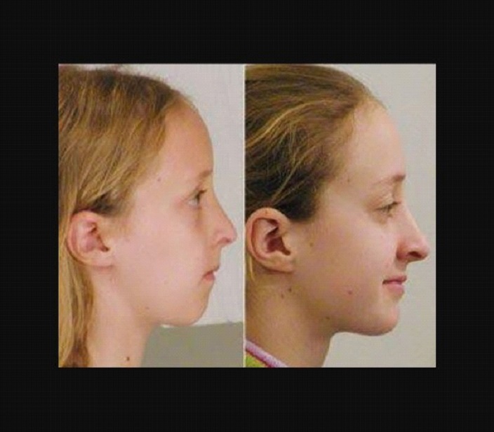 THE BEFORE AND AFTER OF BRACES' EFFECT ON FACE SHAPE